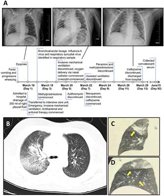 Critical Influenza-Like Illness in a Nine-Year-Old Associated With a Poultry-Origin H9N2 Avian Influenza Virus: Risk Assessment and Zoonotic Potential